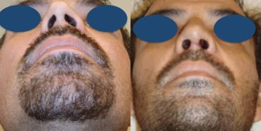 Before and After - Rhinoplasty Colombia - Premium Care Plastic Surgery