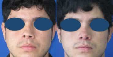 Before and After - Rhinoplasty Colombia - Premium Care Plastic Surgery