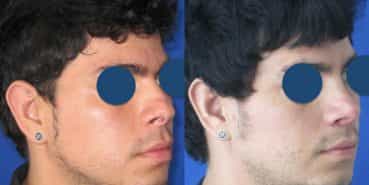 Before and After - Rhinoplasty Colombia - Premium Care Plastic Surgery