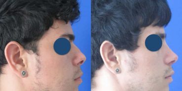 Before and After - Rhinoplasty Colombia - Premium Care Plastic Surgery