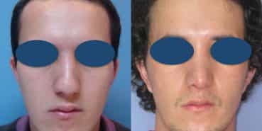 Before and After - Rhinoplasty Colombia - Premium Care Plastic Surgery