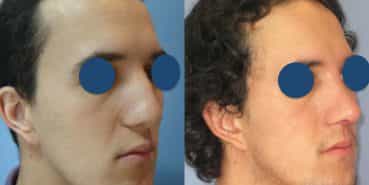 Before and After - Rhinoplasty Colombia - Premium Care Plastic Surgery