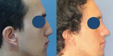 Before and After - Rhinoplasty Colombia - Premium Care Plastic Surgery