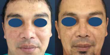 Before and After - Rhinoplasty Colombia - Premium Care Plastic Surgery