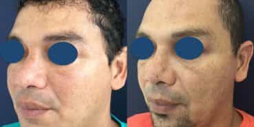 Before and After - Rhinoplasty Colombia - Premium Care Plastic Surgery