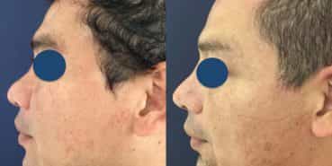 Before and After - Rhinoplasty Colombia - Premium Care Plastic Surgery