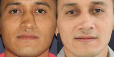 Rhinoplasty Colombia - Premium Care Plastic Surgery