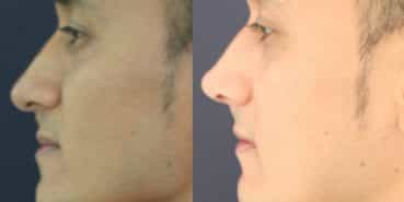 Rhinoplasty Colombia - Premium Care Plastic Surgery