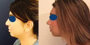 Rhinoplasty Colombia - Premium Care Plastic Surgery