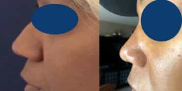 Rhinoplasty Colombia - Premium Care Plastic Surgery