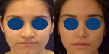 Rhinoplasty Colombia - Premium Care Plastic Surgery