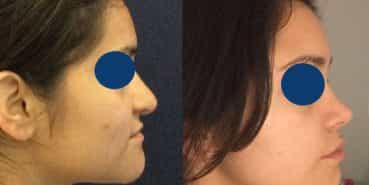 Rhinoplasty Colombia - Premium Care Plastic Surgery