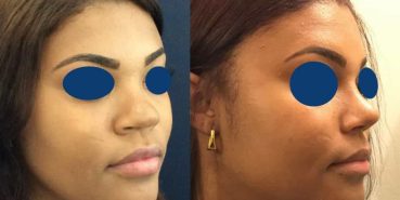 Rhinoplasty Colombia - Premium Care Plastic Surgery