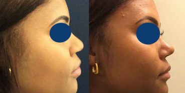 Rhinoplasty Colombia - Premium Care Plastic Surgery