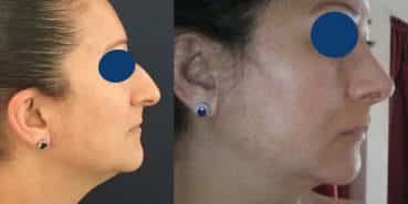 Rhinoplasty Colombia - Premium Care Plastic Surgery