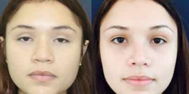 Rhinoplasty Colombia - Premium Care Plastic Surgery