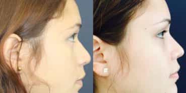 Rhinoplasty Colombia - Premium Care Plastic Surgery