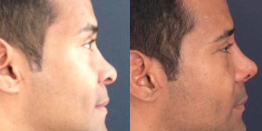 Rhinoplasty Colombia - Premium Care Plastic Surgery