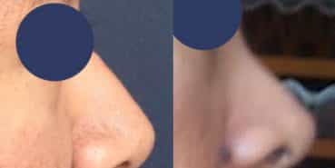 Before and After Rhinoplasty Colombia - Premium Care Plastic Surgery