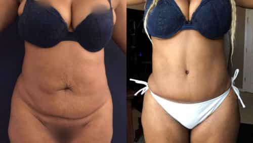Before and After Tummy Tuck Colombia - Premium Care Plastic Surgery