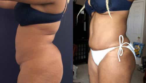 Before and After Tummy Tuck Colombia - Premium Care Plastic Surgery