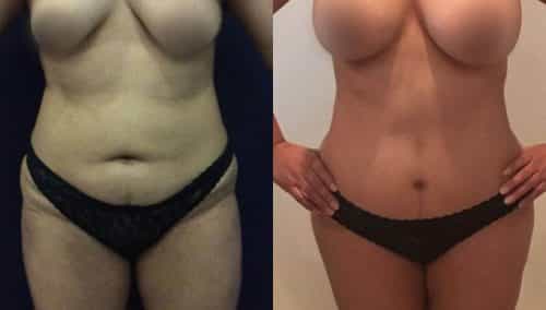 Before and After Tummy Tuck Colombia - Premium Care Plastic Surgery