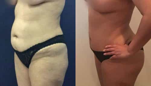 Before and After Tummy Tuck Colombia - Premium Care Plastic Surgery