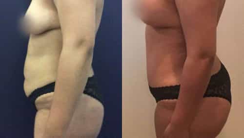 Before and After Tummy Tuck Colombia - Premium Care Plastic Surgery