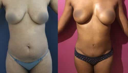 Before and After Tummy Tuck Colombia - Premium Care Plastic Surgery