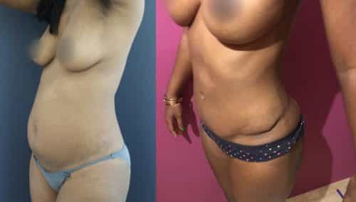 Before and After Tummy Tuck Colombia - Premium Care Plastic Surgery