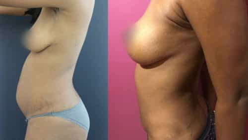 Before and After Tummy Tuck Colombia - Premium Care Plastic Surgery