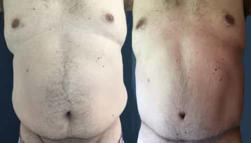Before and After Tummy Tuck Colombia - Premium Care Plastic Surgery