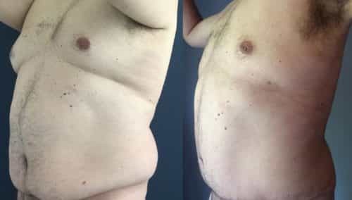 Before and After Tummy Tuck Colombia - Premium Care Plastic Surgery