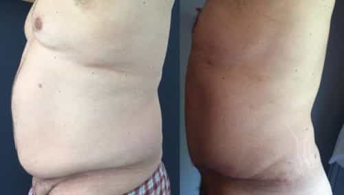 Before and After Tummy Tuck Colombia - Premium Care Plastic Surgery