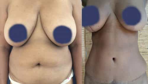 Before and After Tummy Tuck Colombia - Premium Care Plastic Surgery