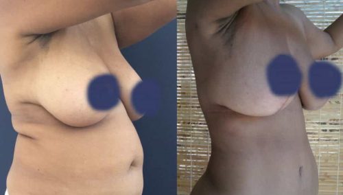 Before and After Tummy Tuck Colombia - Premium Care Plastic Surgery