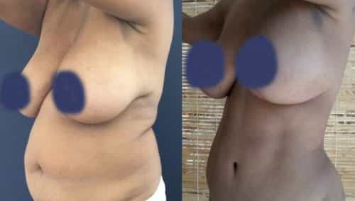 Before and After Tummy Tuck Colombia - Premium Care Plastic Surgery