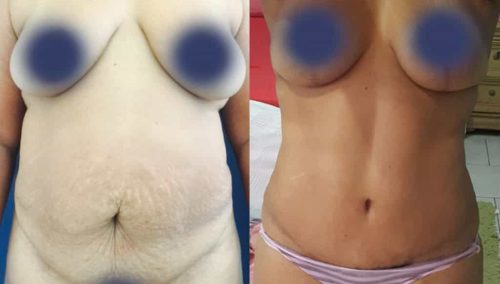 Before and After Tummy Tuck Colombia - Premium Care Plastic Surgery