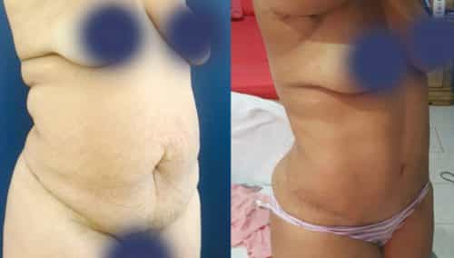 Before and After Tummy Tuck Colombia - Premium Care Plastic Surgery