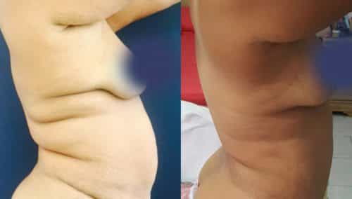 Before and After Tummy Tuck Colombia - Premium Care Plastic Surgery