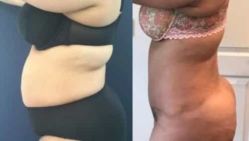 Before and After Tummy Tuck Colombia - Premium Care Plastic Surgery