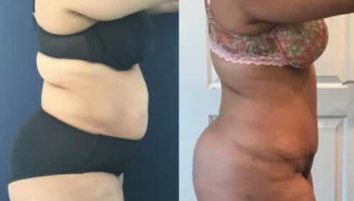 Before and After Tummy Tuck Colombia - Premium Care Plastic Surgery
