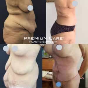 After Weight Loss Surgery Colombia - Premium Care Plastic Surgery