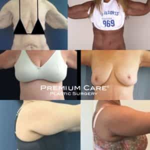 Arm Lift in Colombia at Premium Care Arm Lift in Colombia - Premium Care Plastic Surgery