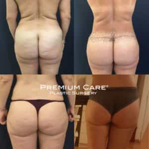 Before and After Body Lift in Colombia at Premium Care Plastic Surgery
