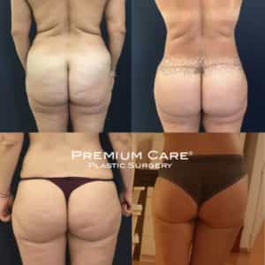 Before and After Body Lift in Colombia at Premium Care Plastic Surgery Before and After Body Lift in Colombia at Premium Care Plastic Surgery