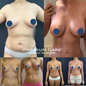 Breast Augmentation in Colombia - Premium Care Plastic Surgery