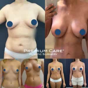 Breast Augmentation in Colombia - Premium Care Plastic Surgery Breast Augmentation in Colombia - Premium Care Plastic Surgery
