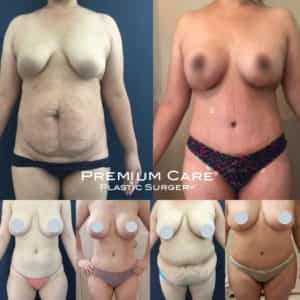 Brest Lift in Colombia - Premium Care Plastic Surgery Breast Lift in Colombia - Premium Care Plastic Surgery