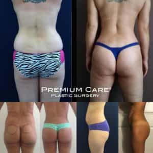 Buttock Augmentation Colombia - Premium Care Buttock Augmentation in Colombia - Premium Care Plastic Surgery